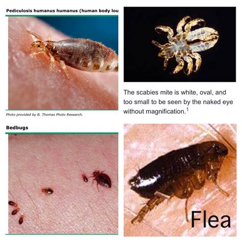 blood sucking louse, insect without wings. . Pictures of body lice and scabies